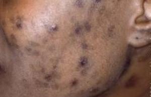 Dark Spots: An Effective Home Remedy