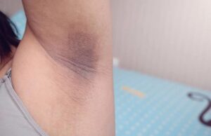 4 natural remedies to getting rid of dark underarms